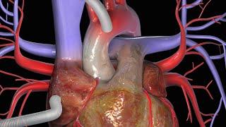 Heart Bypass Surgery (CABG)