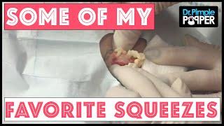 In Memory of some of My Favorite Squeezes: Dr Pimple Popper