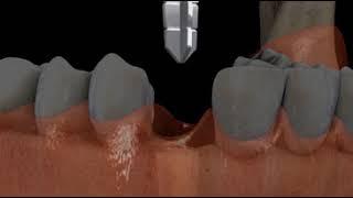 Implant In 2 step Anterior