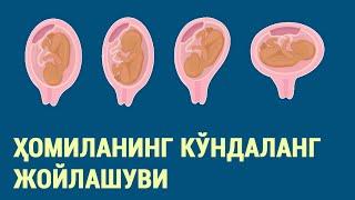 Ҳомиланинг кўндаланг жойлашуви