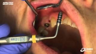 Astra Tech Implant System EV - Soft tissue measurement using Abutment Depth Gauge EV