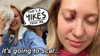 EMERGENCY ROOM VISIT, STITCHES, AND A BLACK EYE | what really happened