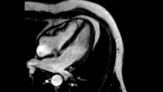 Constrictive pericarditis four-chamber, ECG-gated cine SSFP MR