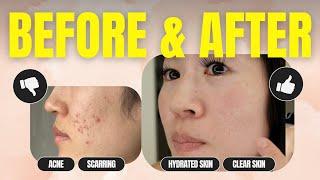 My ENTIRE Asian Skincare Routine (*and How I Overcame My Acne )