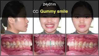 Class I Deep Bite with Gummy Smile｜【Chris Chang Ortho】CC799