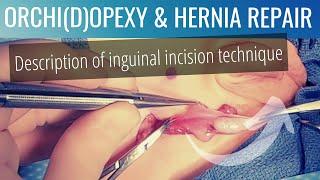 Inguinal orchidopexy (orchiopexy) and herniorrhaphy (hernia repair): description of technique