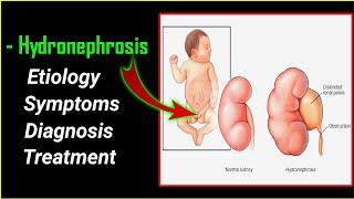 Hydronephrosis , symptoms, diagnosis and treatment @ImMEDICAL.