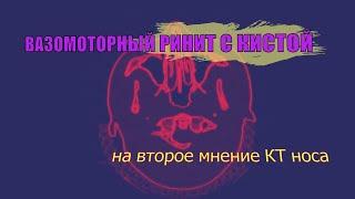 КИСТА в левой пазухе носа и ВАЗОМОТОРНЫЙ РИНИТ на расшифровке КТ пазух носа (ВТОРОЕ МНЕНИЕ КТ)