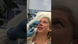 Under Eye Dark Circle Solution - Tear Trough Correction with Dermal Filler