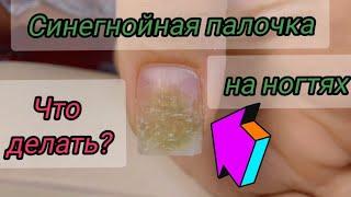 ЧТО ДЕЛАТЬ с псевдомонией на ногтях? Простые и эффективные советы