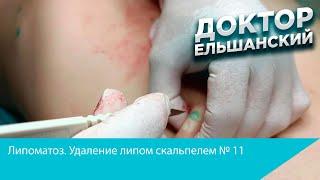 Липоматоз  Удаление липом скальпелем № 11