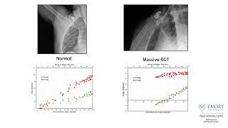 Massive Rotator Cuff Tear | Orthopedic Applications for DDR | Konica Minolta