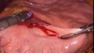 Laparoscopic Sleeve Gastrectomy by WAEL TOBAR MD