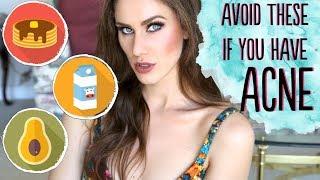 3 FOODS YOU SHOULDN'T EAT IF YOU HAVE ACNE
