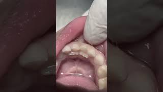 Extraction of deciduous teeth #dentist