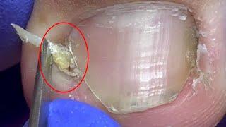 Wow~ Slowly dig out the hooks under the toenails and give the lady a pedicure【Doctor Liu Pedicure】
