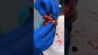 Specimen Examination: Robotic Right Middle Lobectomy for Adenocarcinoma #surgeon #doctor #medical