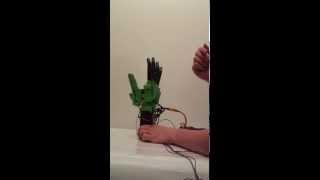 First Prototype Bionic Hand for a Transradial Ampute