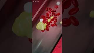 Coronary Artery Disease (CAD): Guide to heart health
