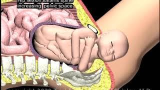 Shoulder Dystocia McRoberts Maneuver Animation by Cal Shipley, M.D.