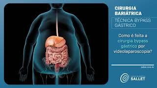 Como é realizada a técnica Bypass gástrico?