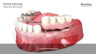 Partial denture