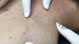 New Blackheads & Cystic Removal For Boy 2024| Acne Perennial On Back