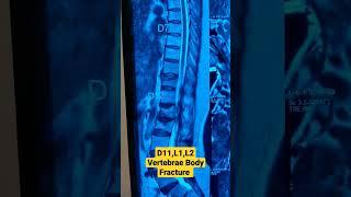 D11,L1,L2 Vertebrae Body Fracture ..Dr Sai Chandra MBBS DNB Ortho