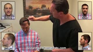 Natural Hair Transplant Clinic In Arlington Heights, Illinois -  Dr. Brett Bolton