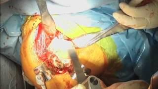 Reverse total shoulder arthroplasty (shoulder replacement) video