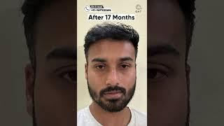 seventeen Months Hair Transplant Results | Latest Fue Technique #shorts #viral #hair transplant