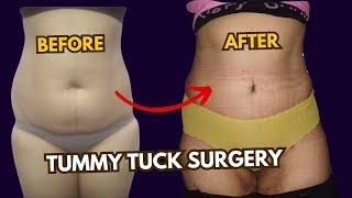 Tummy Tuck Surgery Result | 2-Stage Procedure for Flat & Toned Tummy