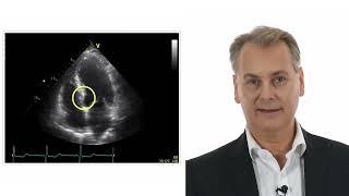 Case: Wall motion abnormality in an inferior infarct