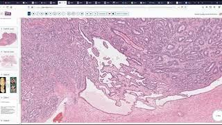 Retiform Sertoli Leydig Cell Tumor of Ovary