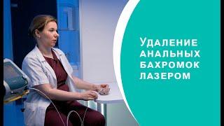 Удаление анальных бахромок лазером