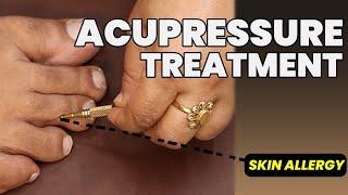 Skin Allergy Ka Acupressure Treatment