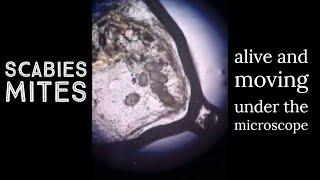 Scabies - moving around on mineral oil skin scraping preparation
