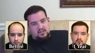 Dr. Brett Bolton Outrageous Hair Transplant Surgery Result