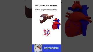 Why Do Neuroendocrine Tumor Liver Metastases (NELMs) Return After Surgery? Micrometastatic Disease