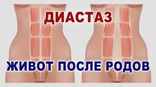 Диастаз что это Качать ли пресс после родов? Как убрать живот после родов Почему диастаз после родов