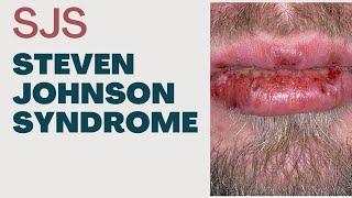 Steven Johnson Syndrome || SJS