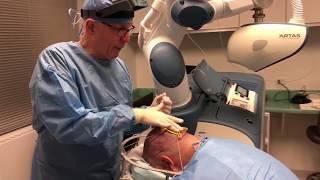 Simultaneous Robotic Incision and Manual Extraction using the ARTAS 9X