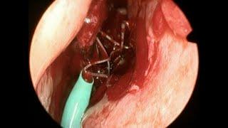 Insertion of PROPEL® Contour Implant after Sinus Surgery