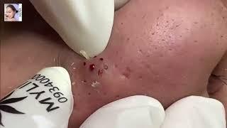 Super Hard Nose Blackheads removal Satisfying !   Anna Facial Treatment   001