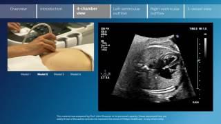 Key screening views of the fetal heart - Part 3 - 4-chamber view