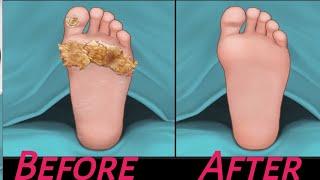 ASMR Treatment athlete's foot and warts between toes at home | Foot care animation