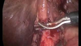 laparoscopic CBDexploration for impacted CBD stone
