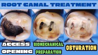 Root Canal Treatment  Mandibular Molar 🟡Access Opening🟢Biomechanical Preparation ️ Obturation