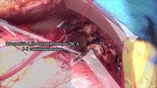 lt thoracotomy Total Arch Replacement + thoracoabdominal aortic replacement