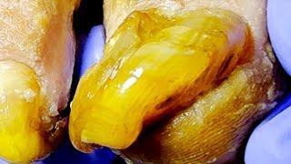 Jade Like Onychomycosis, Complete Trimming Process【Dr. Liu's Pedicur】